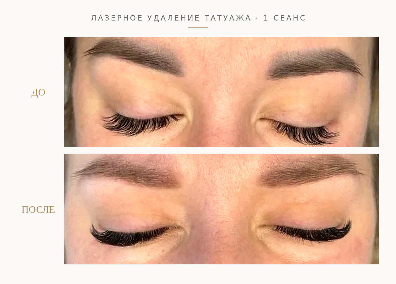 Лазерное удаление татуажа · 1 сеанс